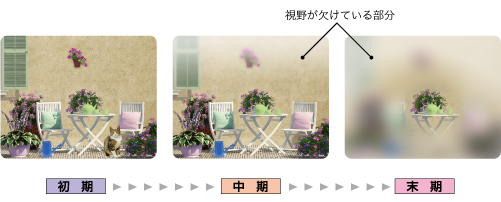 緑内障の症状の進み方
